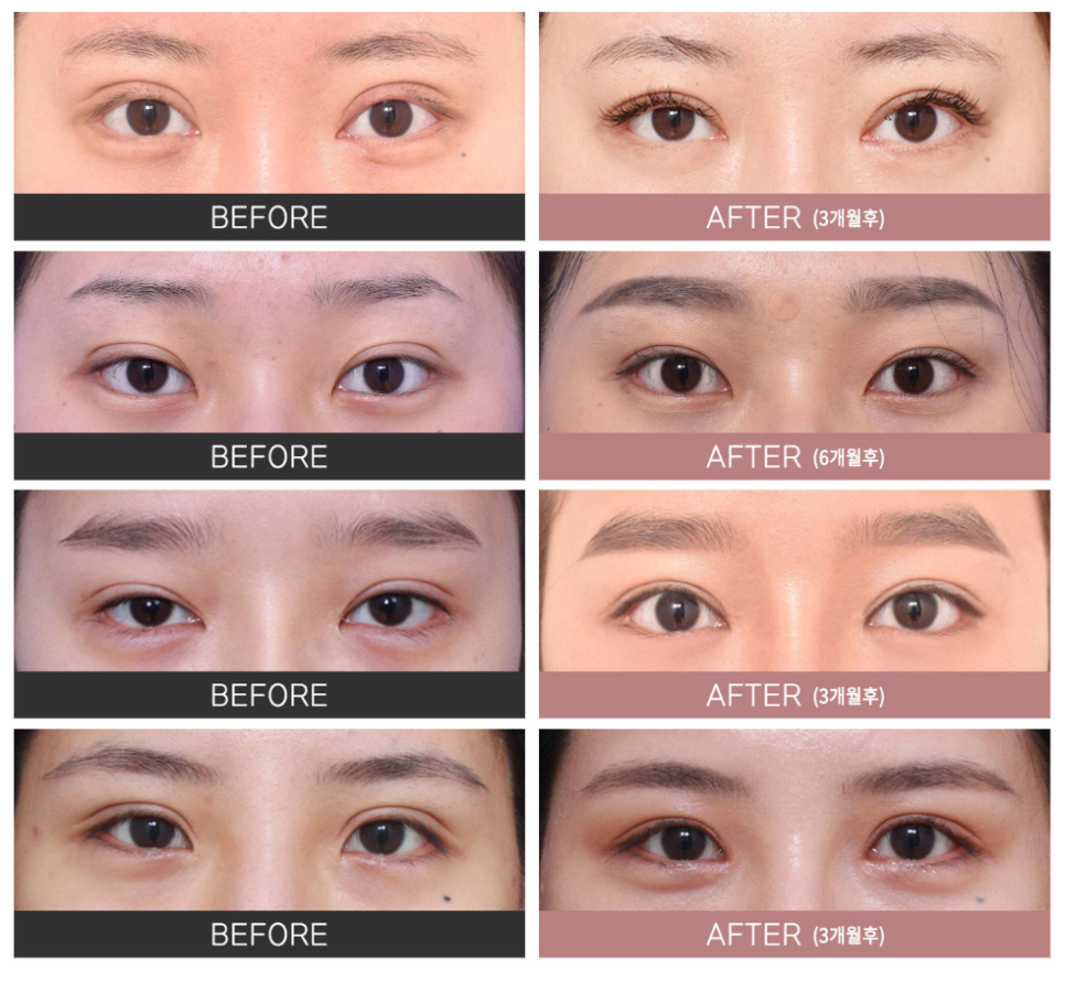 실패 없는 자연스러운 쌍꺼풀을 위한 선택 , 강남역눈재수술 잘하는 병원 관련 이미지 3