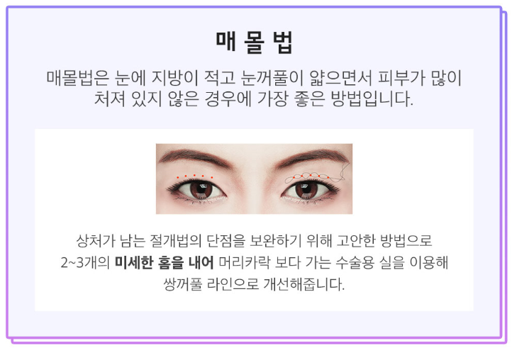 쌍꺼풀수술 비용부터 수술방법까지 관련 이미지 6