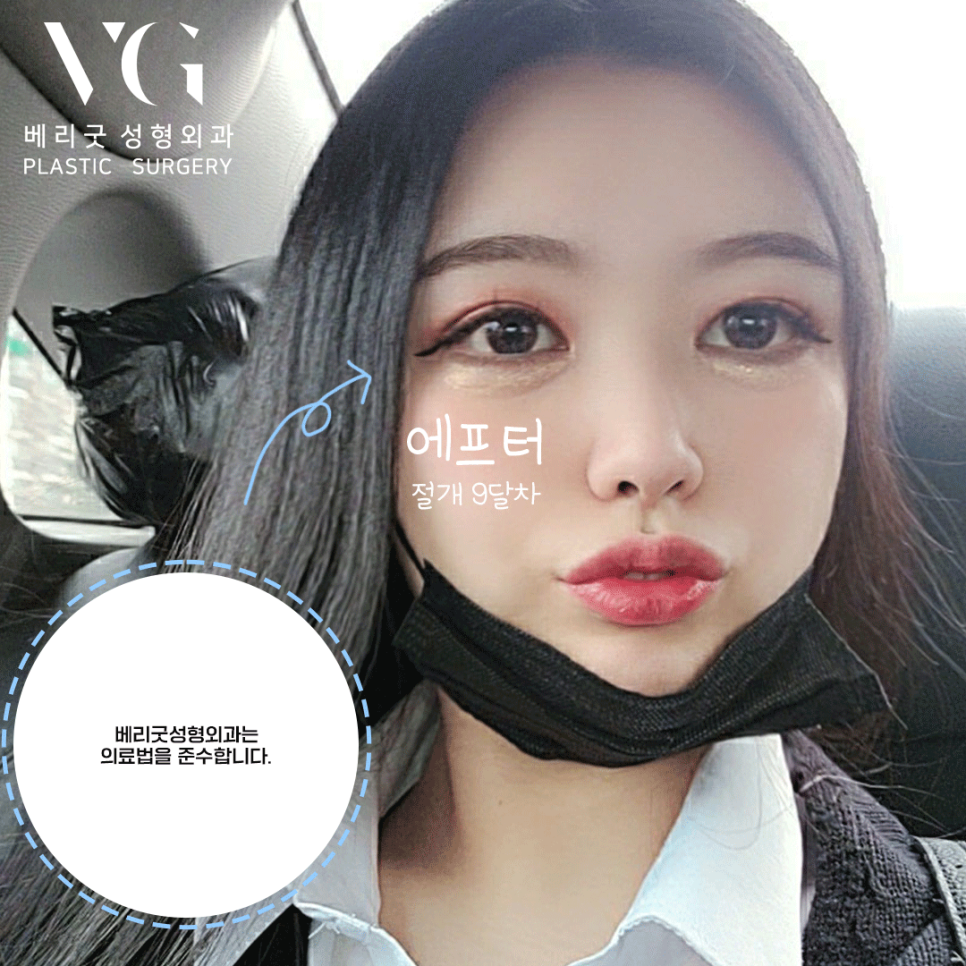 절개 쌍커풀 쌍수👀❣ 잘하는곳 베리굿성형외과❤ 관련 이미지 6