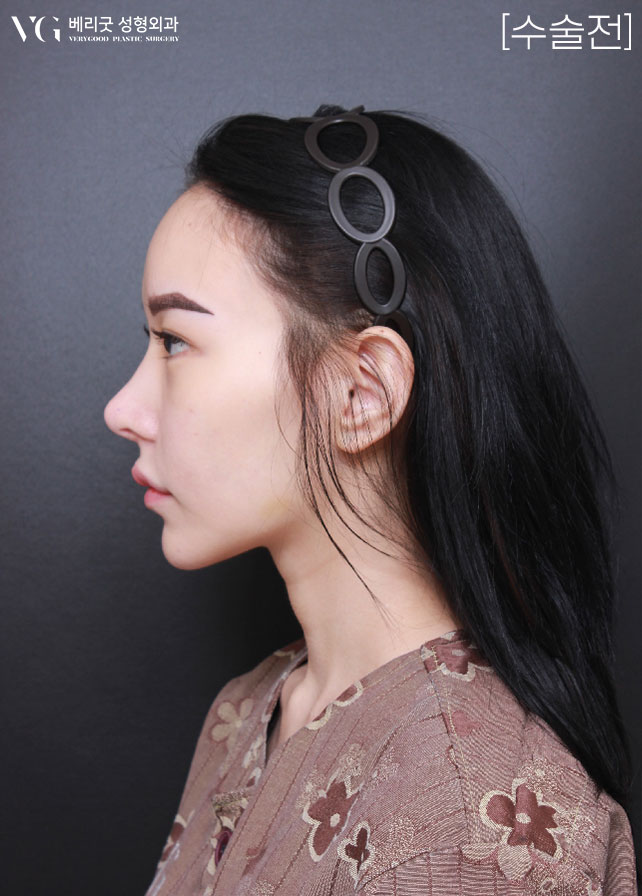 [베리굿성형외과]안면윤곽 리얼전후! 관련 이미지 4