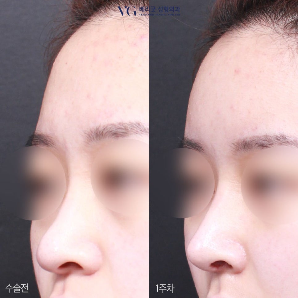 직반코성형? 베리굿성형외과💙 화려하게,자연스럽게✨ 관련 이미지 7