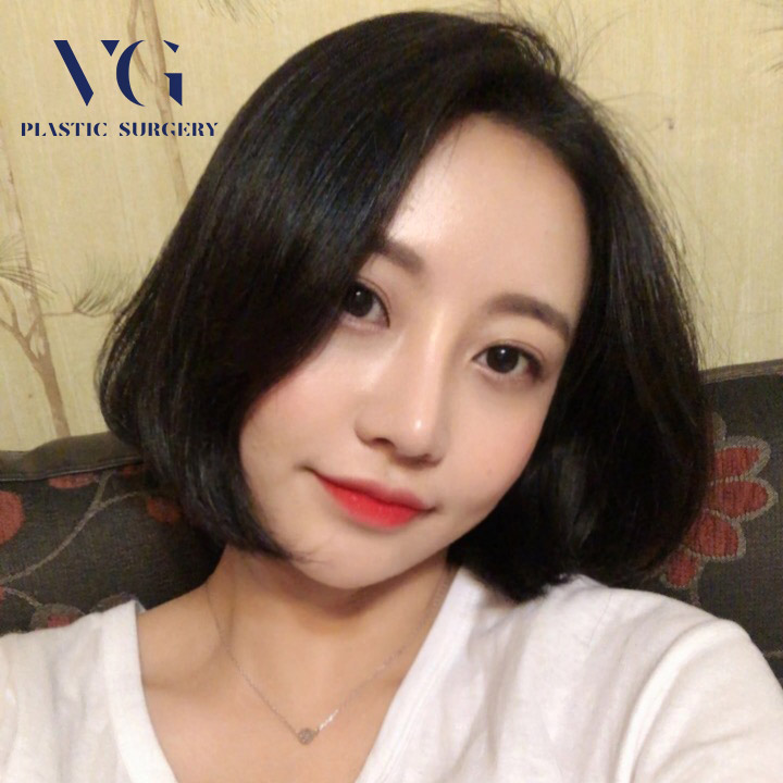 눈밑지방재배치후기 밝고 환해진 인상 관련 이미지 3