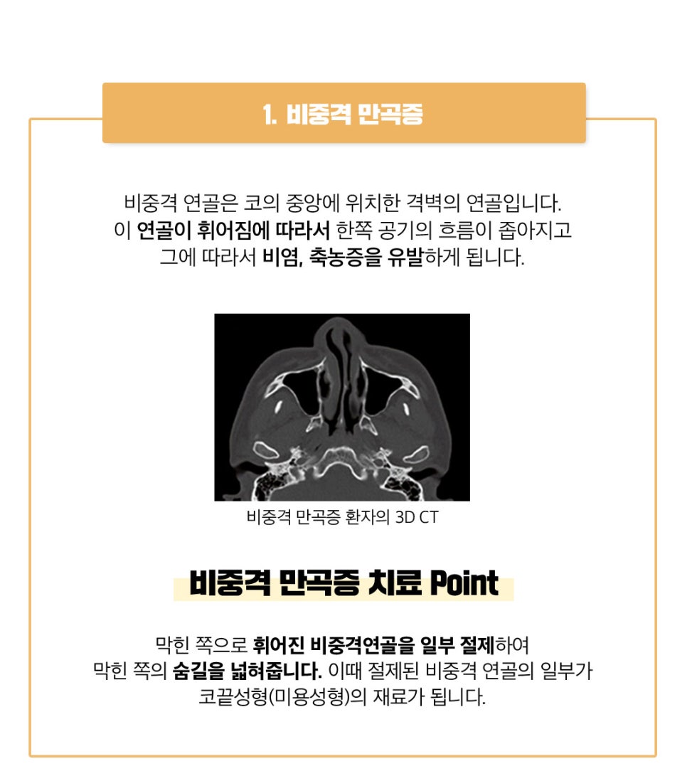 비염코성형 원인 파악부터 비용까지 관련 이미지 5