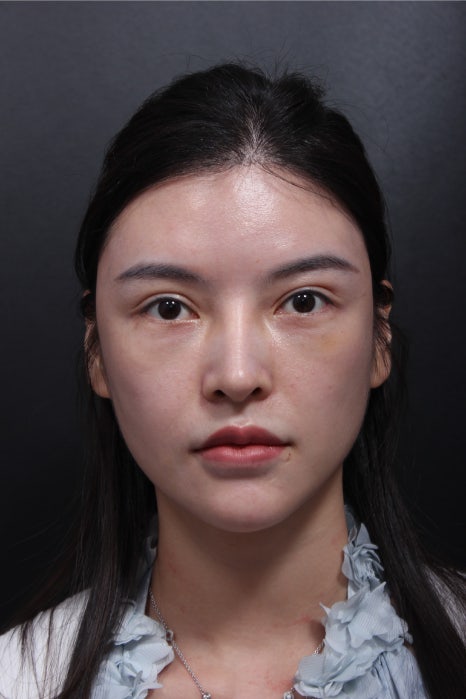 어려보이는 윤곽수술과 코재수술 관련 이미지 2