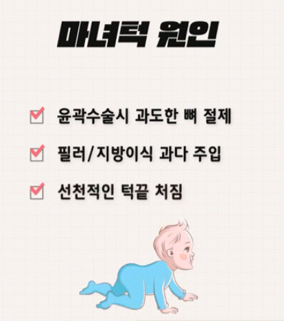 강남역 마녀턱 턱끝거상 , 리프팅원인 수술방법 총정리 관련 이미지 7