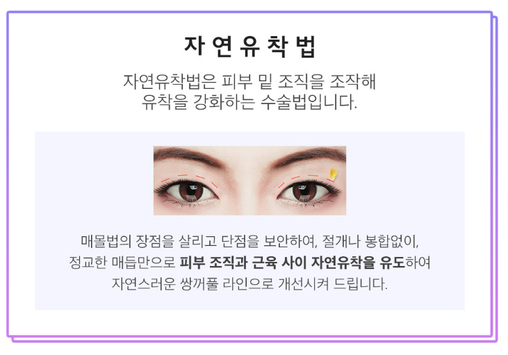 쌍꺼풀수술 비용부터 수술방법까지 관련 이미지 7