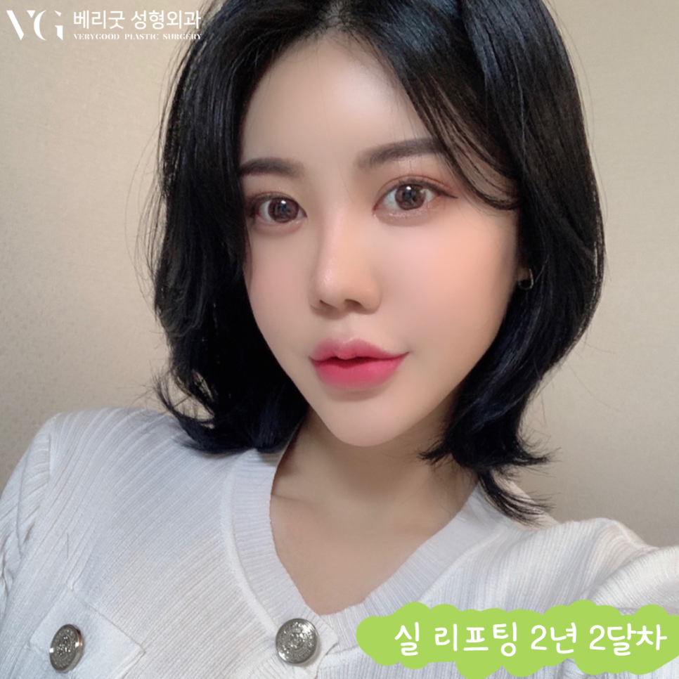 베리굿성형외과❤20,30대도 가볍게 받을 수 있는 실리프팅☝☝ 관련 이미지 4