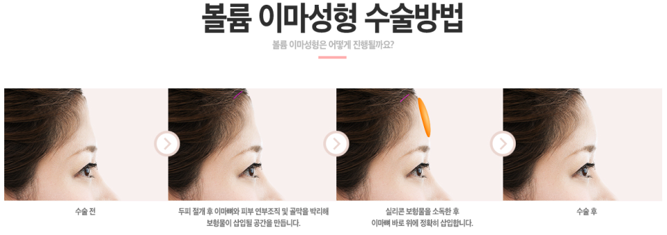 베리굿성형외과 볼륨 이마성형, 내 이마는 어디에...? 관련 이미지 5