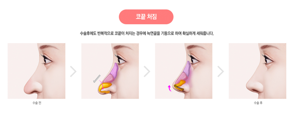 베리굿성형외과의 VERYGOOD한! 자가늑코재수술 전후 관련 이미지 7