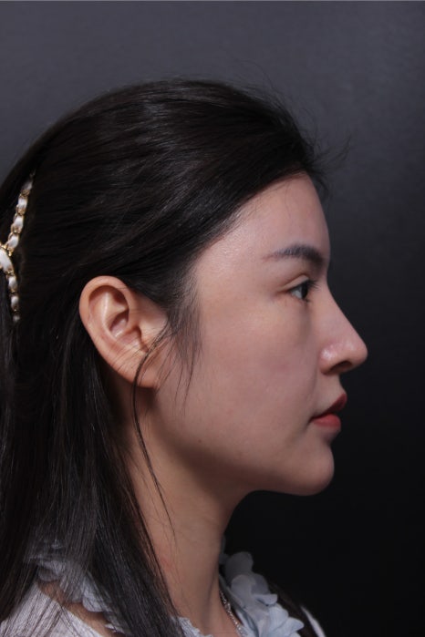 어려보이는 윤곽수술과 코재수술 관련 이미지 1