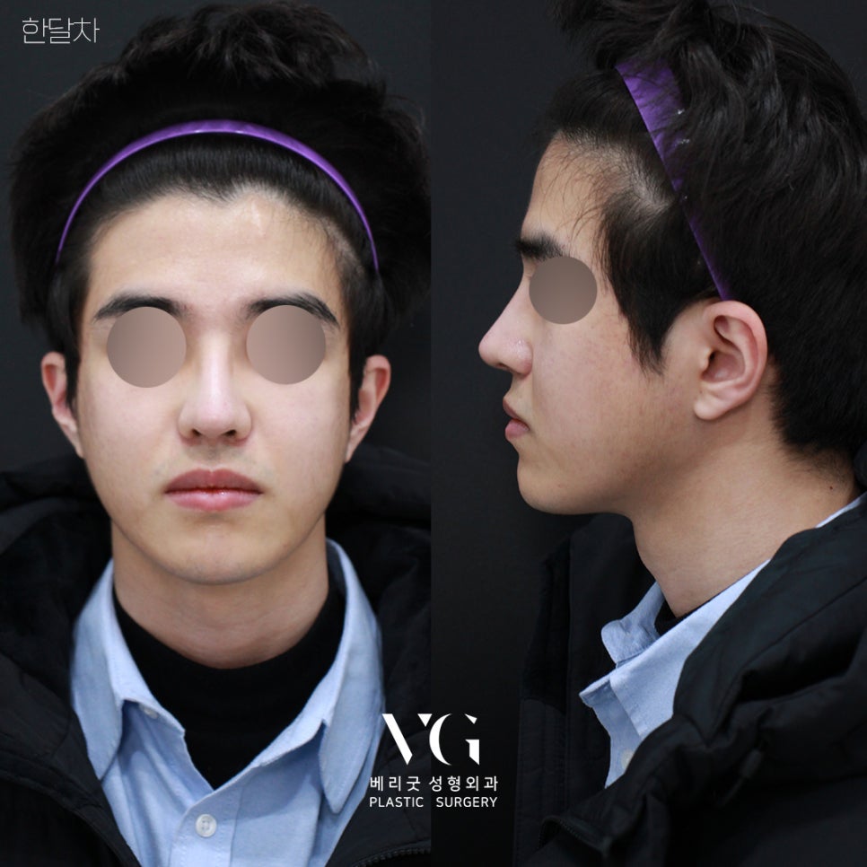 [ 베리굿성형외과 ] 안면윤곽 3종 Special한 REAL 전후비교 관련 이미지 3