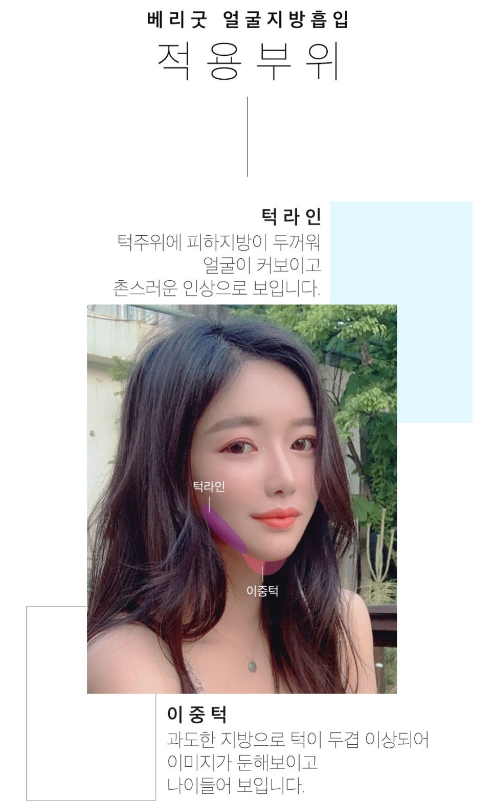 지방흡입으로 안면윤곽의 효과를?? 관련 이미지 3