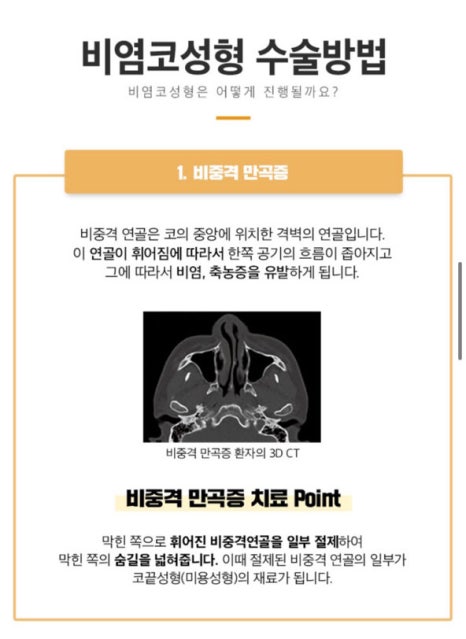 베리굿 비염코성형✨비염수술과 코성형을 동시에? 관련 이미지 4