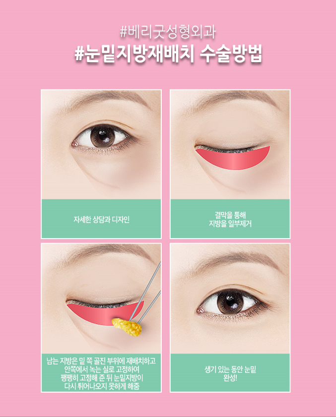 눈밑지방재배치수술로 팬더탈출! 재발없는 수술하는법? 관련 이미지 6
