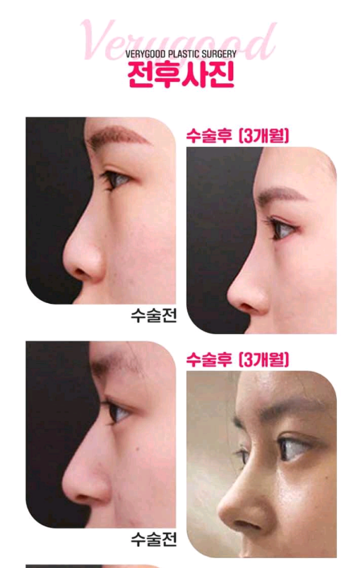 베리굿성형외과-MZ코,내돈 내산 코성형후기 mz세대의 유행하는 코성형은? 코성형부작용 1일차,3일차,1달차,전후후기 관련 이미지 4