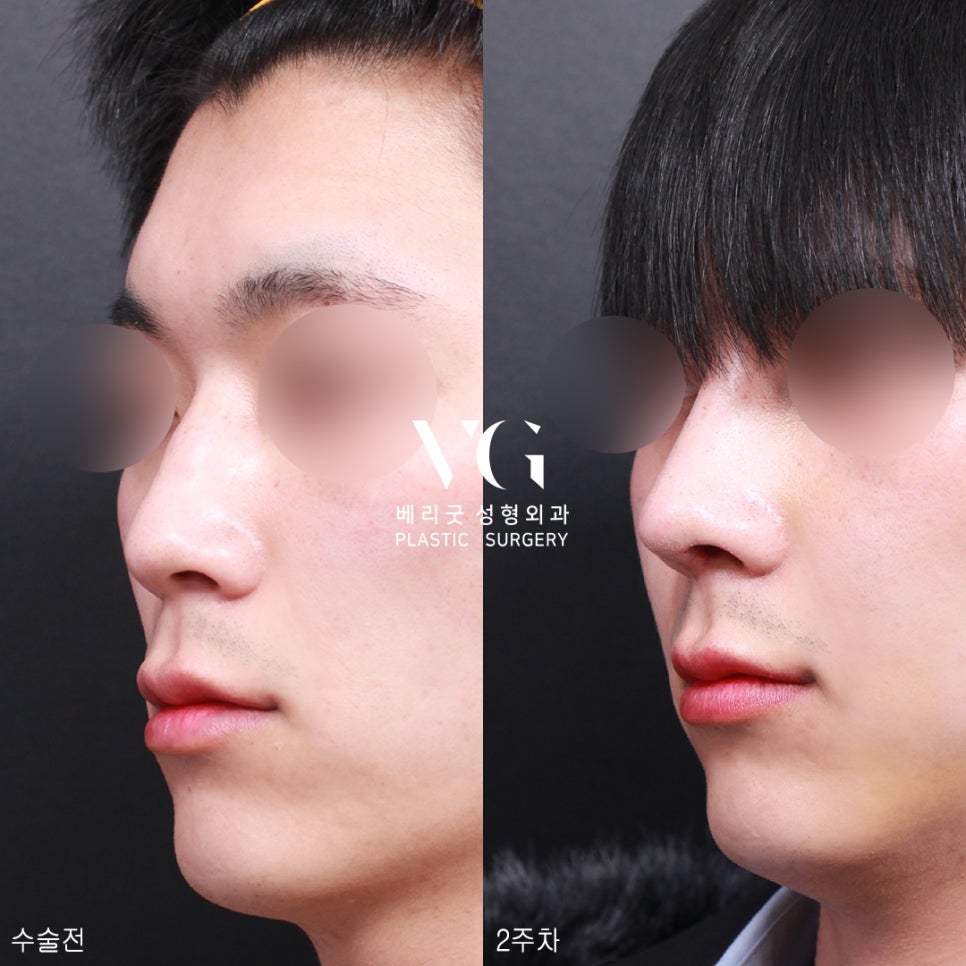 남자코성형전후가 궁금해?남자코성형도 베리굿성형외과💙 관련 이미지 4