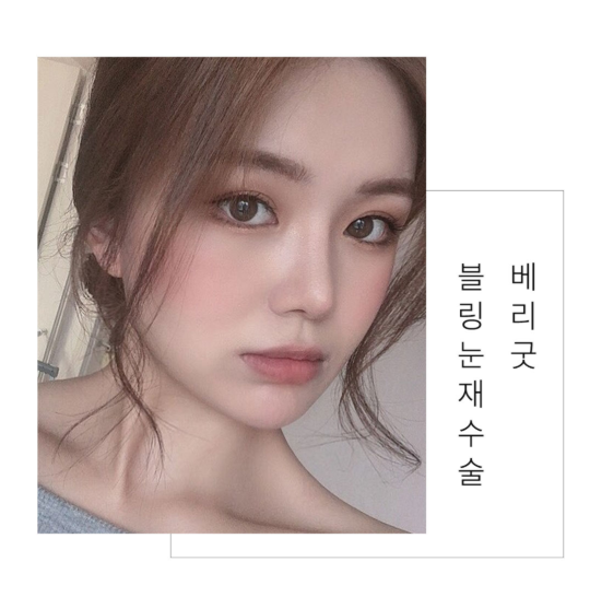 베리굿 눈재수술로 마지막을 완성하다! 관련 이미지 5