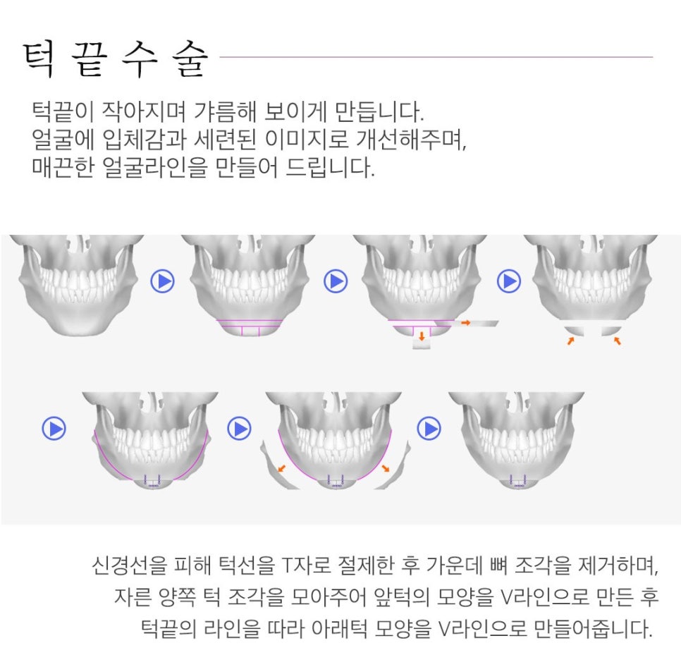 자연스러운 얼굴 라인~베리굿 남자 안면윤곽 관련 이미지 5