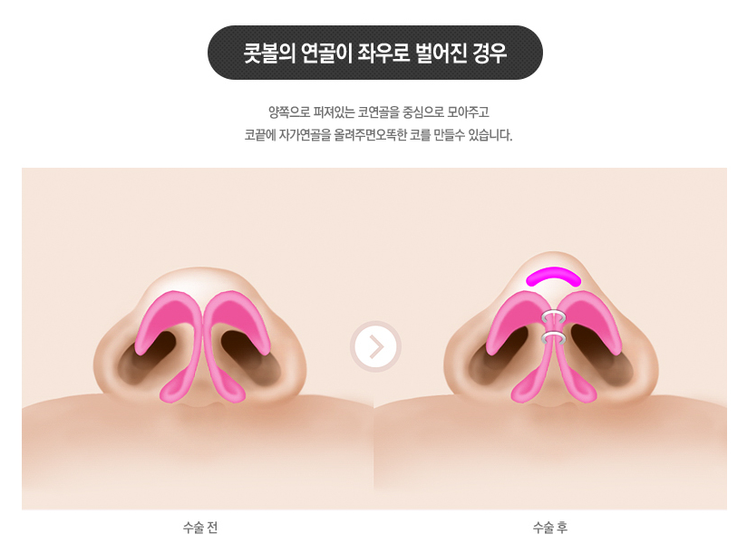 #복코성형 #복코수술 역시😘 #베리굿성형외과 관련 이미지 4