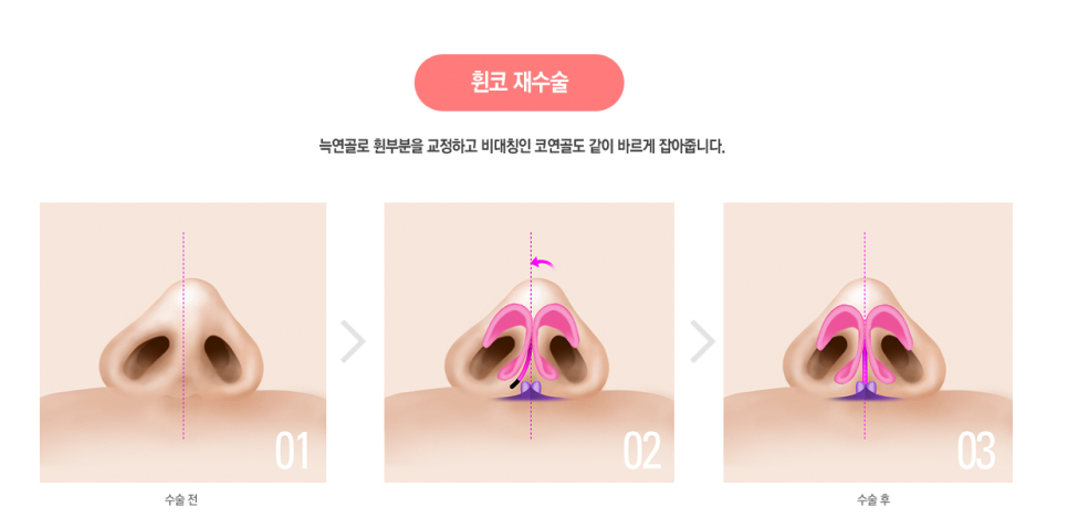 베리굿에서 자가늑연골로 베리굿하게 코수술하자💜 관련 이미지 7