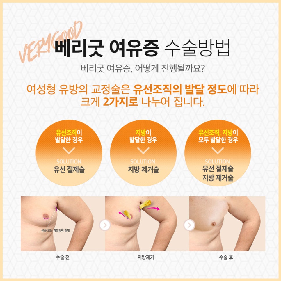 남자여유증수술 베리굿성형외과👨&zwj;⚕️ 관련 이미지 4