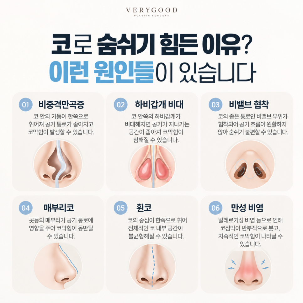 코막힘이 운동할 때 더 심해진다면? 숨쉬기 불편한 코와 기능코성형 관련 이미지 2