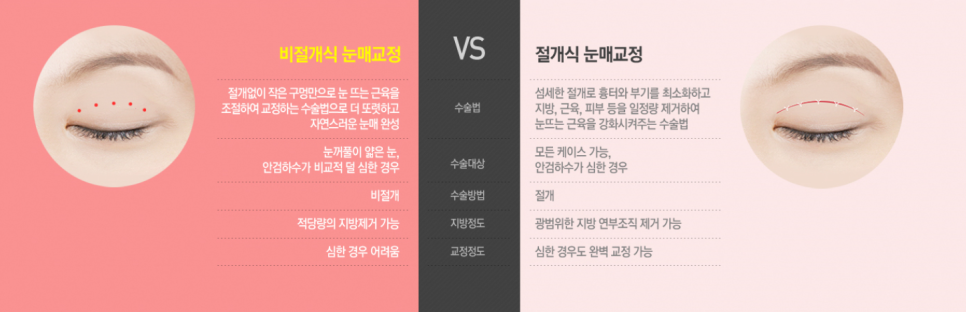 안검하수, 눈매교정으로 개선할수있다? 관련 이미지 2