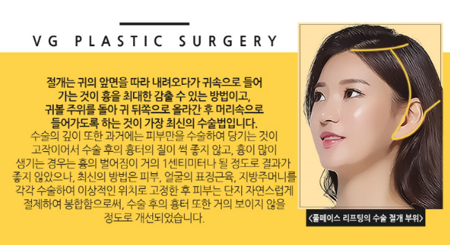 안면거상술 확실한 리프팅효과 관련 이미지 4
