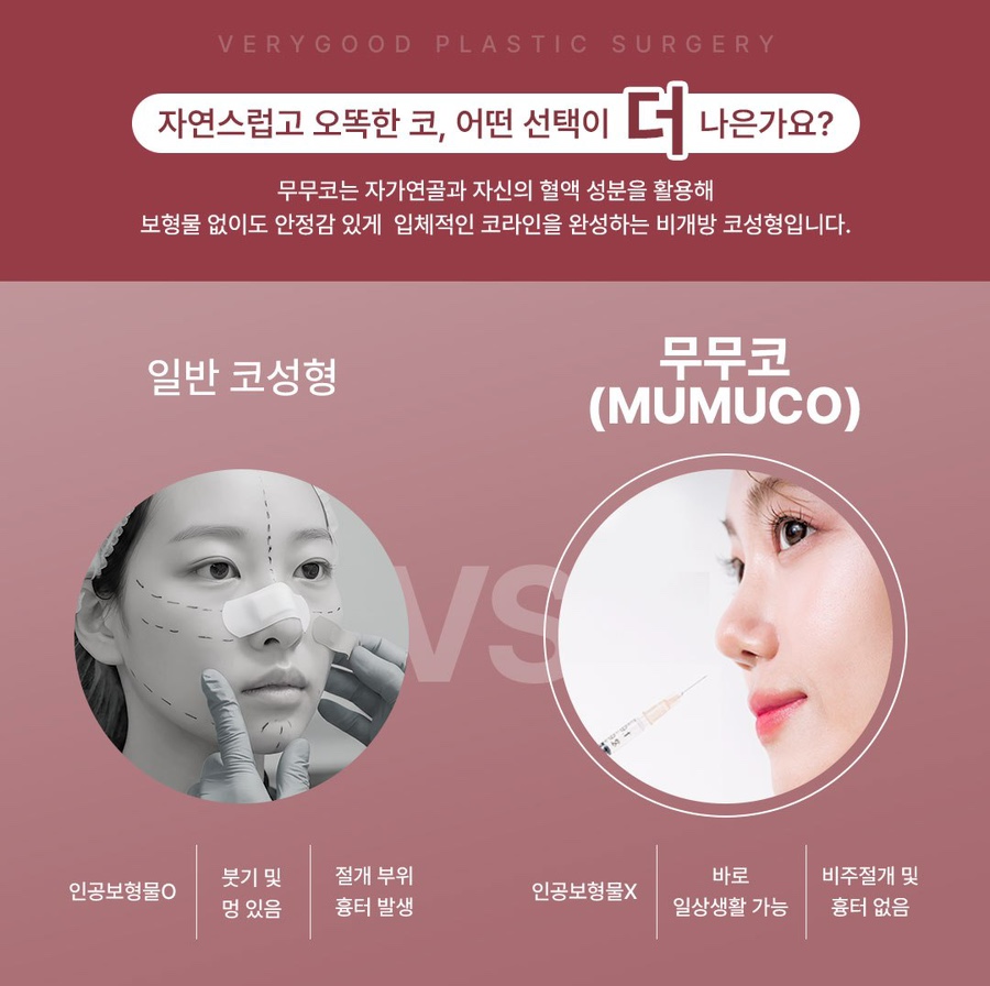 자연스러운 무보형물 코성형, 베리굿성형외과 무무코가 정답인 이유 관련 이미지 3
