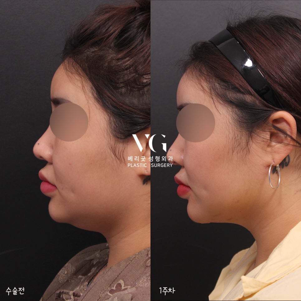 베리굿 얼굴지방흡입 전후💖밖에서 언제까지 마스크 쓸래? 관련 이미지 7