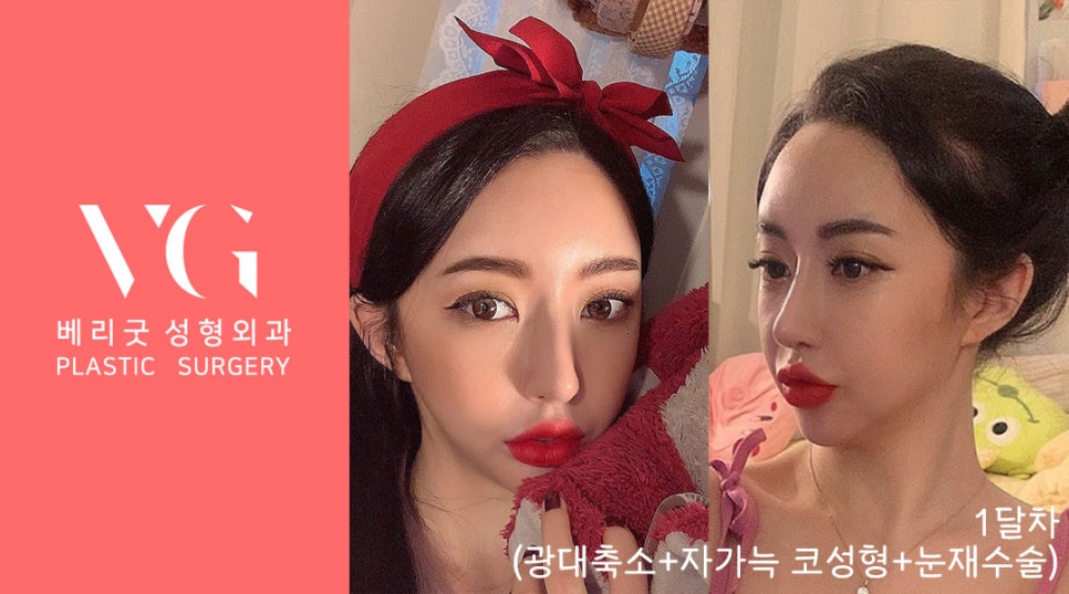 베리굿성형외과 (광대축소+눈재수술+자가늑 코) 리얼스토리💯 관련 이미지 4