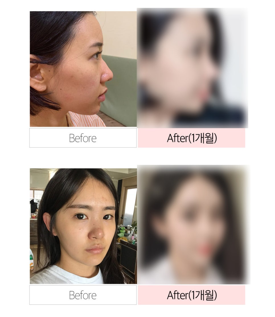 비염코성형 원인 파악부터 비용까지 관련 이미지 13