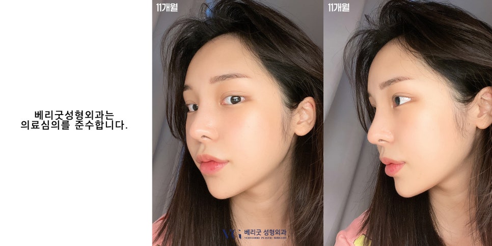 V라인 턱끝성형✌ 윤곽수술도 역시 베리굿성형외과 관련 이미지 6