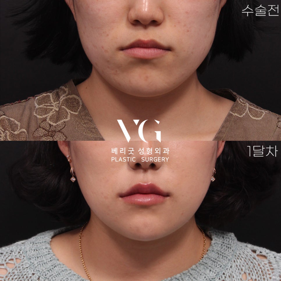 VERY GOOD LINE✨ V라인 턱끝축소 REAL전후 관련 이미지 3