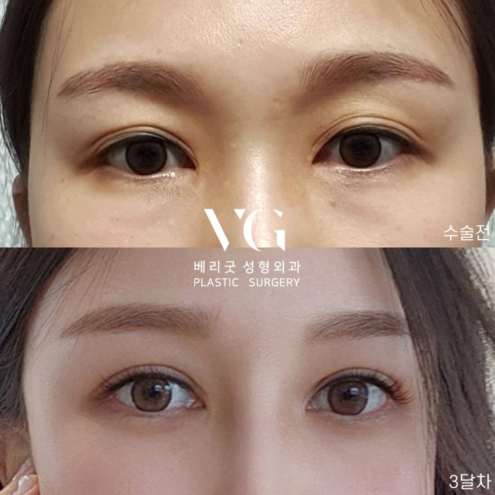 마지막은 쌍수는 베리굿에서 블링블링하게 베리굿 눈재수술전후👀✨ 관련 이미지 5