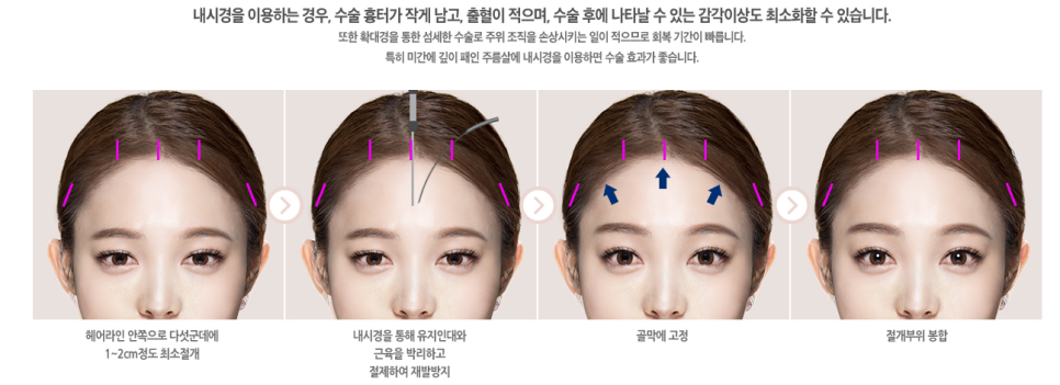 답답한 눈매? 무거운 눈? 베리굿 이마거상전후로 해결👀💖 관련 이미지 5