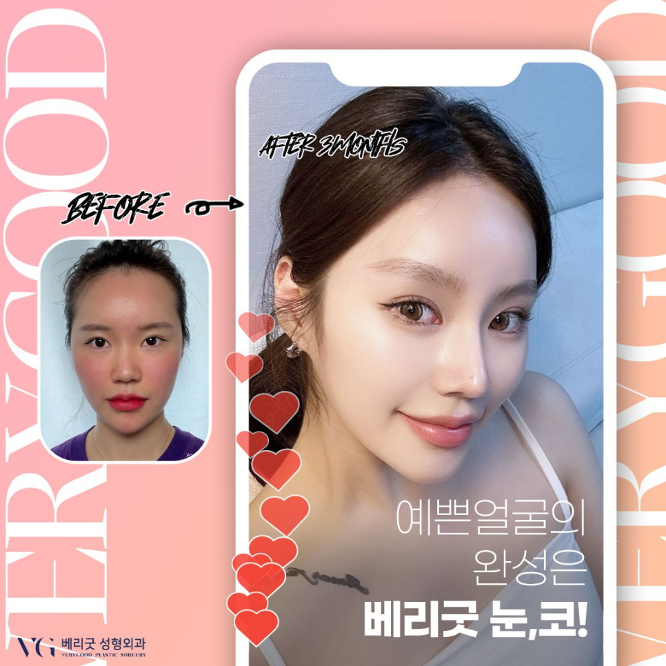 강남코성형잘하는병원 ,  어딜가야 성공할지 고민된다면 관련 이미지 9