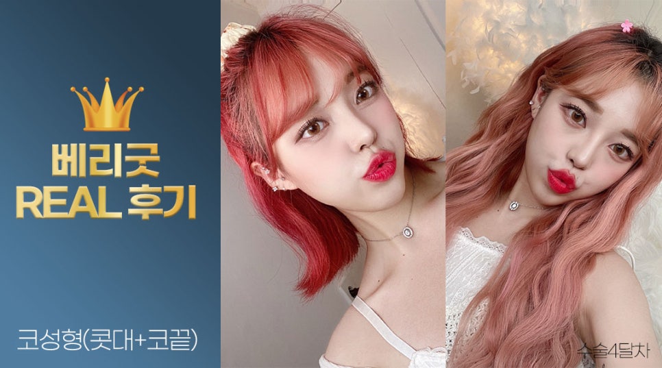 내가 예뻐진 이유❣ 베리굿성형외과 강남역 코성형 리얼후기✨ 관련 이미지 4