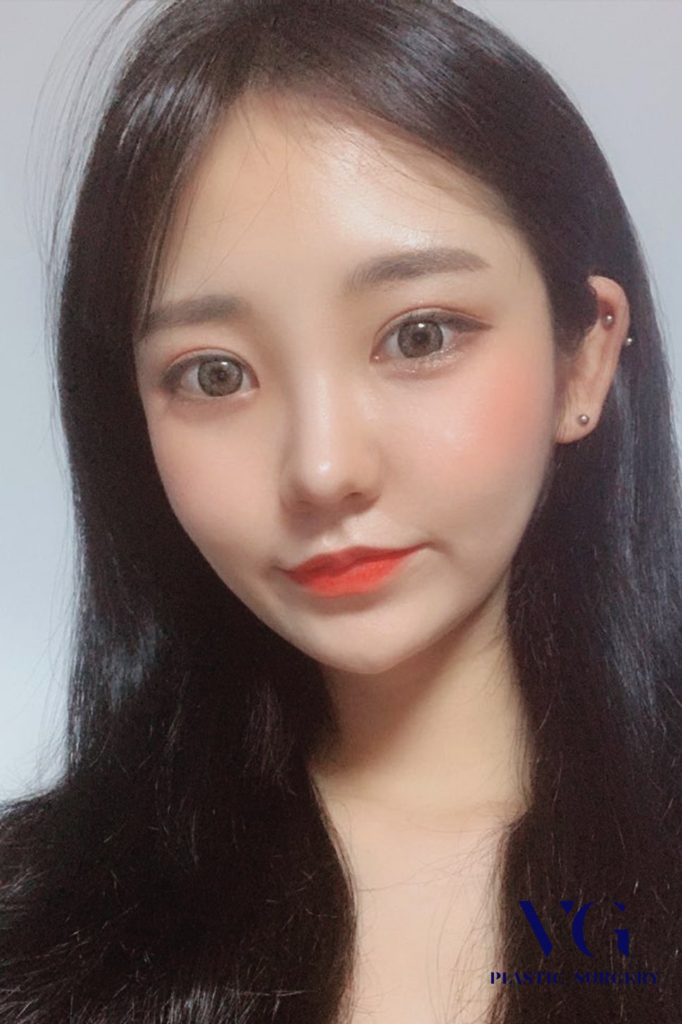 넓은 이마고민, 이마축소로 얼만큼 줄일 수 있을까?? 베리굿 이마축소후기로 확인하자! 관련 이미지 3