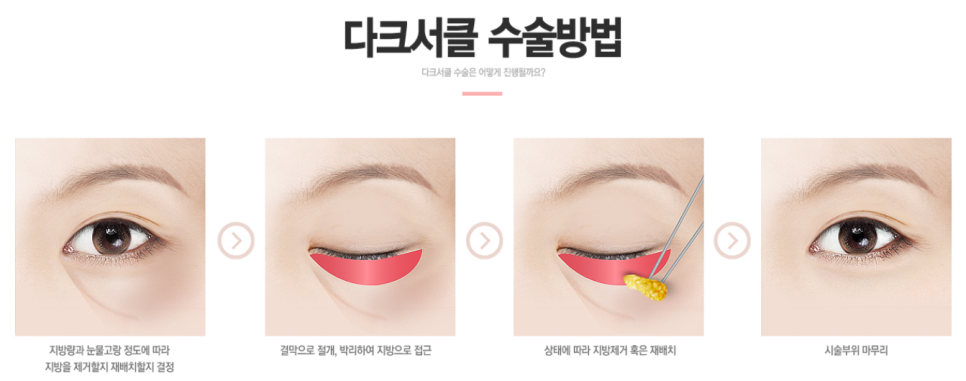 눈밑지방재배치후기 밝고 환해진 인상 관련 이미지 4