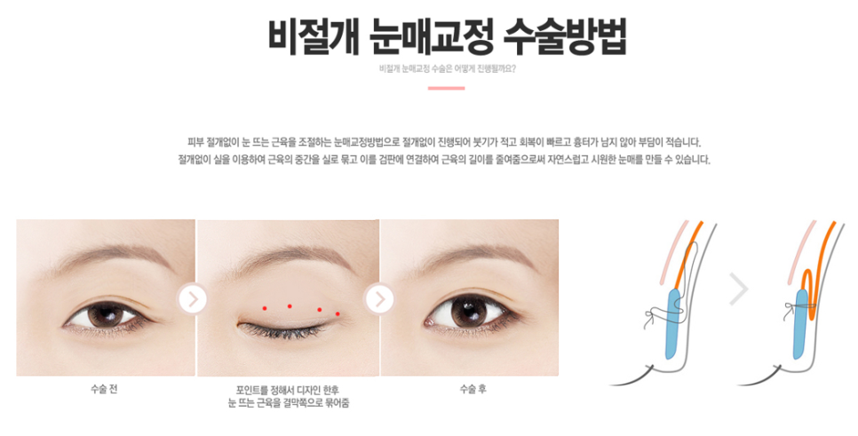 남자눈매교정전후 확실하게 관련 이미지 4