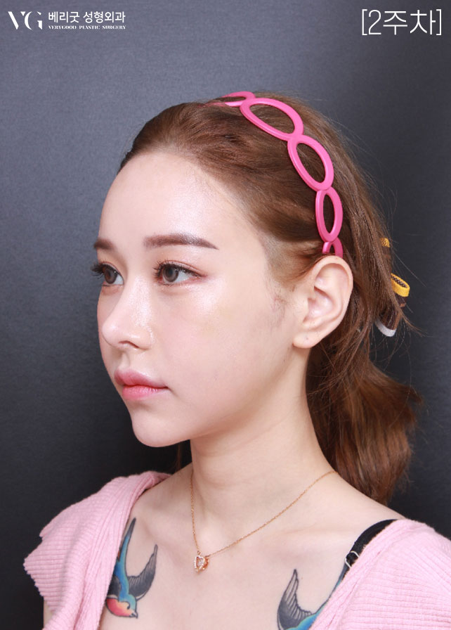 [베리굿성형외과]안면윤곽 리얼전후! 관련 이미지 7