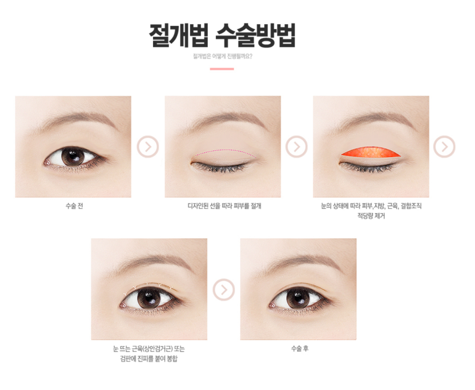 강남쌍꺼풀수술성형외과 , 나한테 맞는 수술방법 디자인으로 눈성형 성공하려면 관련 이미지 7