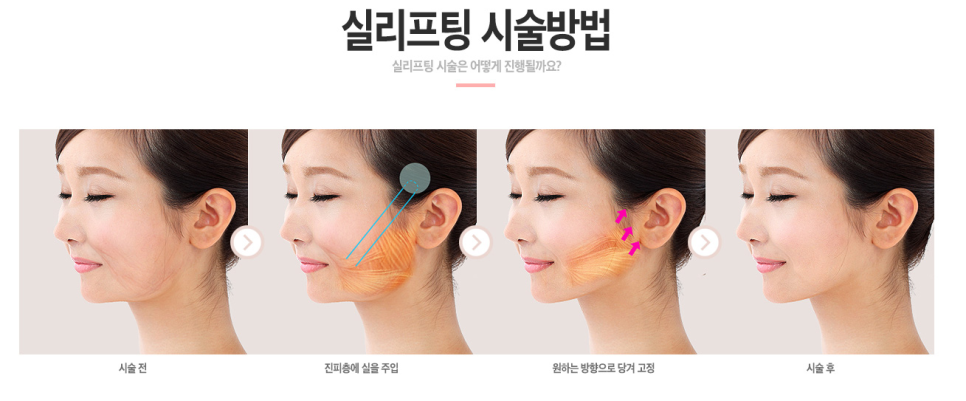 베리굿성형외과❤20,30대도 가볍게 받을 수 있는 실리프팅☝☝ 관련 이미지 6