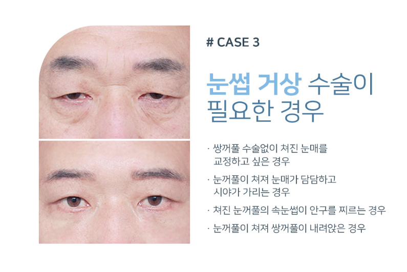 처진 눈꺼풀로 답답한 인상, 강남역 중년 눈성형으로 교정하기 관련 이미지 4