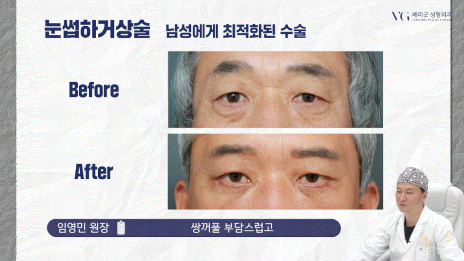 강남중년눈성형 잘하는곳 , 상안검 하안검 눈썹하거상술종류 진행방법 궁금하다면 관련 이미지 23