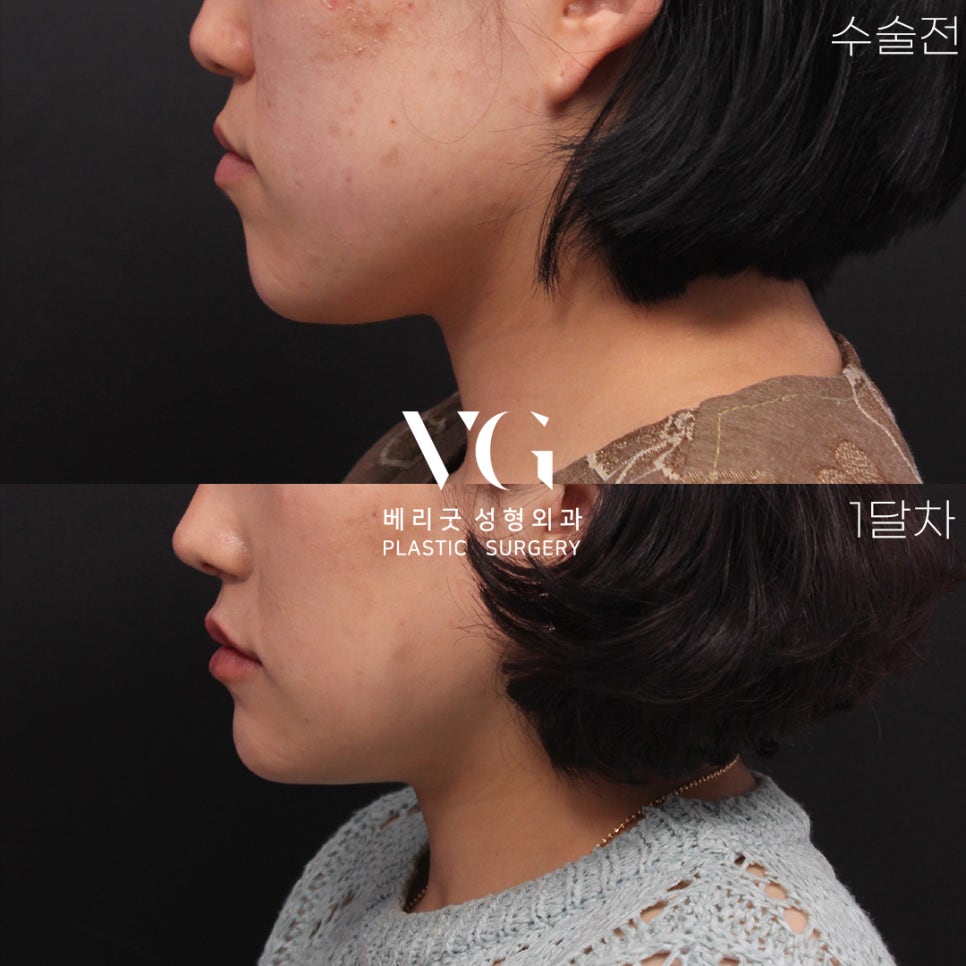 VERY GOOD LINE✨ V라인 턱끝축소 REAL전후 관련 이미지 1