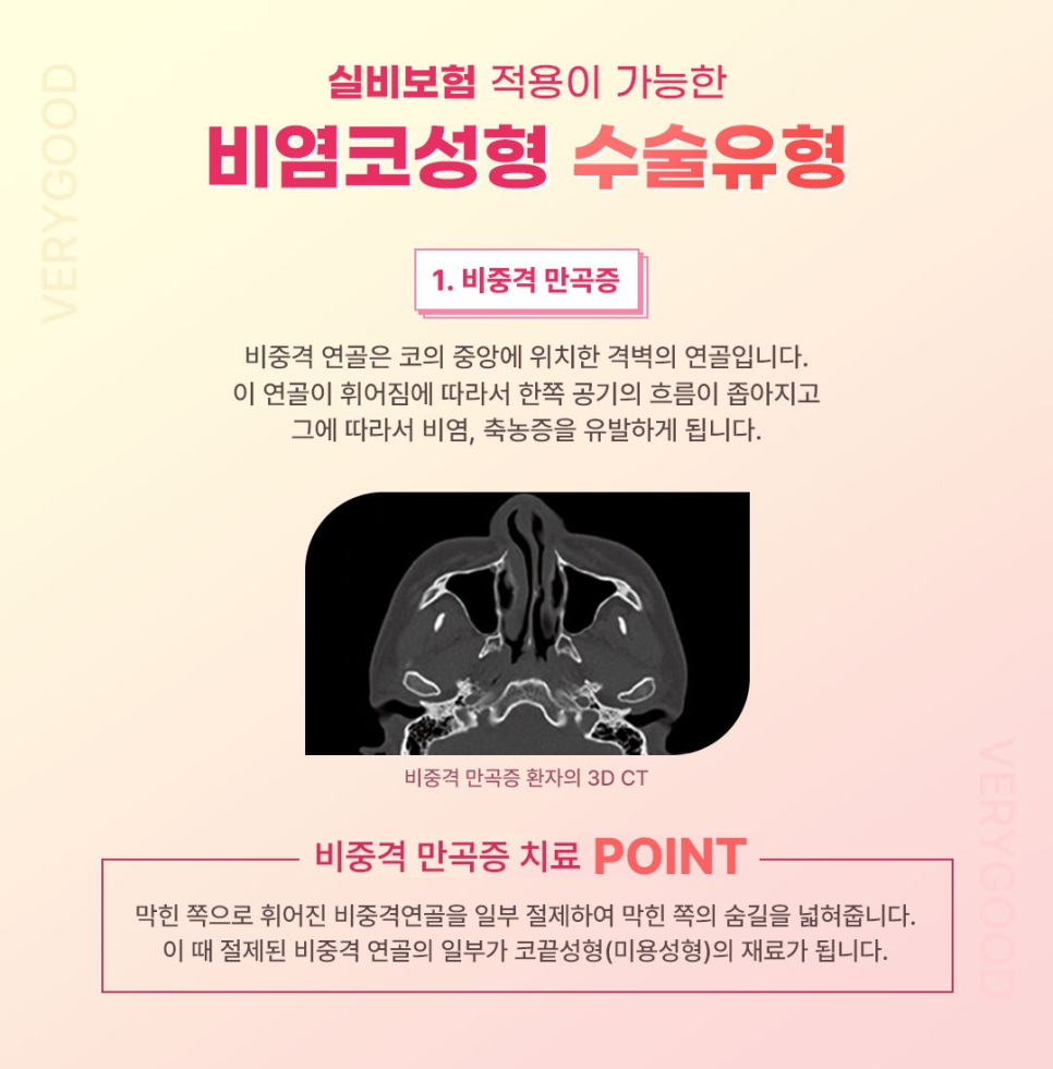 콧물&middot;코막힘&middot;재채기&hellip;비염도 치료하고 코모양도 예뻐지고 싶다면? 강남 비염코성형 관련 이미지 4