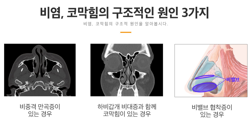 베리굿 비염코성형❤기능과 미용을 동시에?!😍 관련 이미지 3