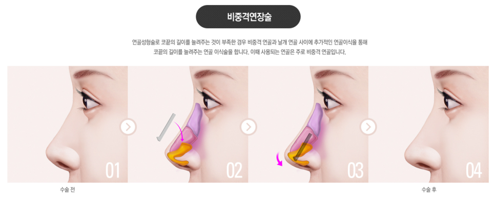 베리굿성형외과 기증늑연골 짧은코교정💖 관련 이미지 9